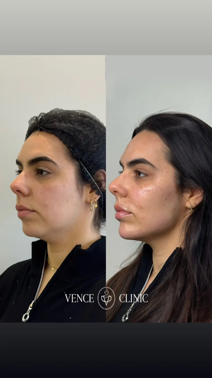 Antes e depois de uma paciente da Vence Clinic