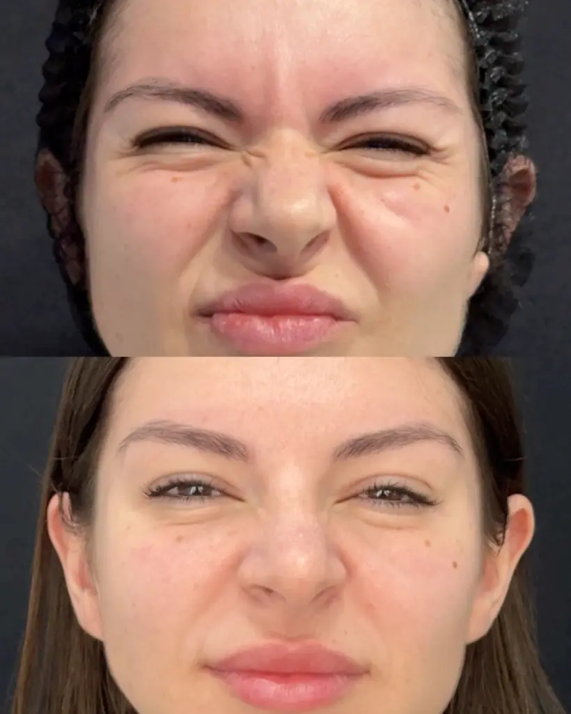 Antes e depois de uma paciente da Vence Clinic