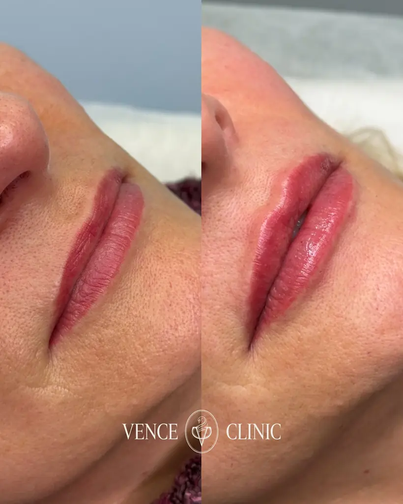 Antes e depois de uma paciente da Vence Clinic