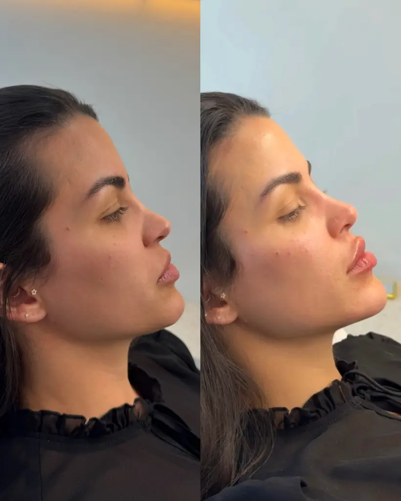 Antes e depois de uma paciente da Vence Clinic