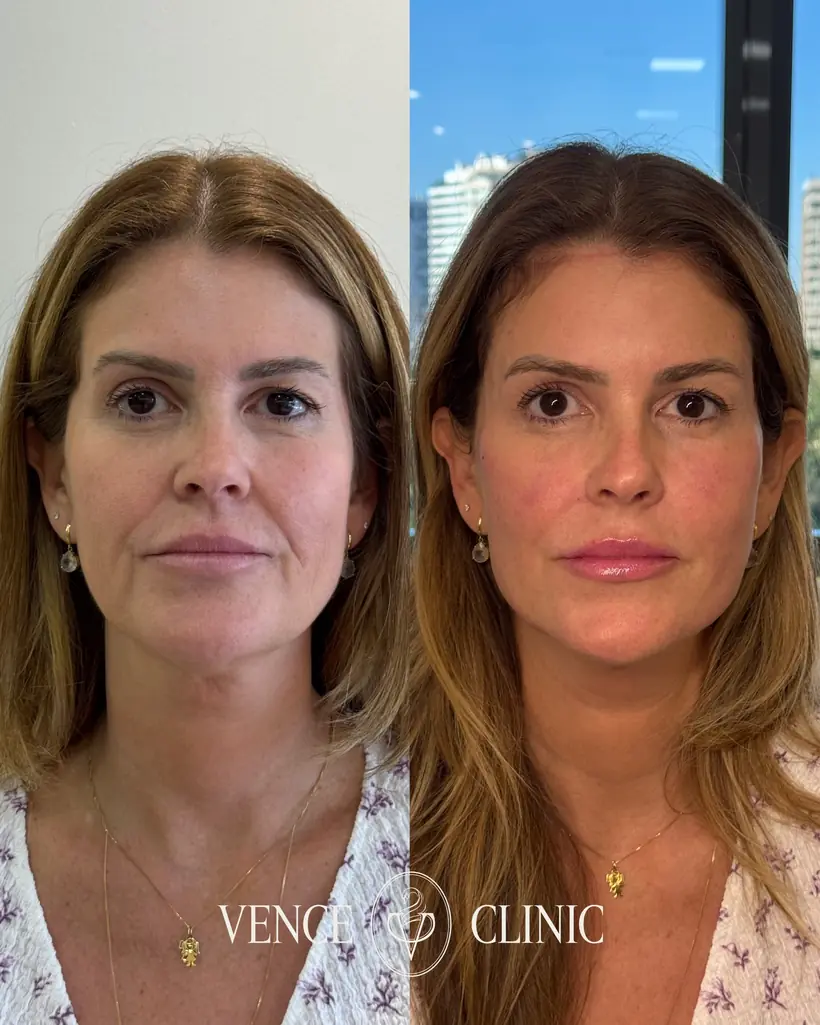 Antes e depois de uma paciente da Vence Clinic