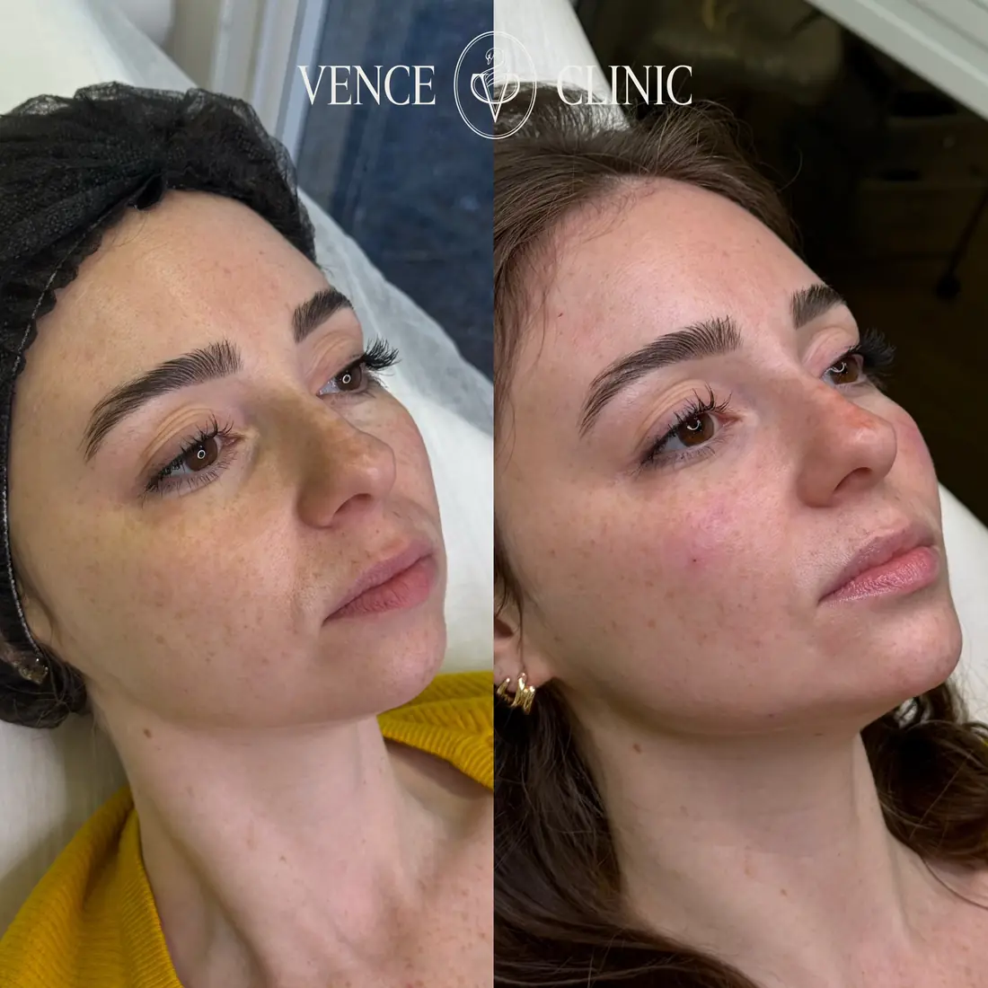 Antes e depois de uma paciente da Vence Clinic